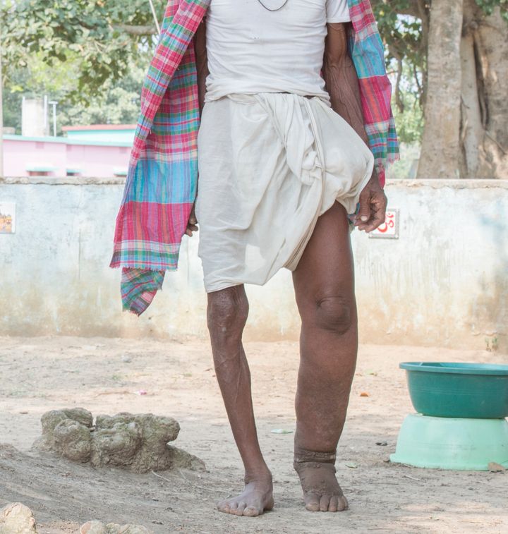 A man in India displaying symptoms of lymphatic filariasis, commonly known as elephantiasis, a neglected tropical disease that causes skin and tissue swelling.