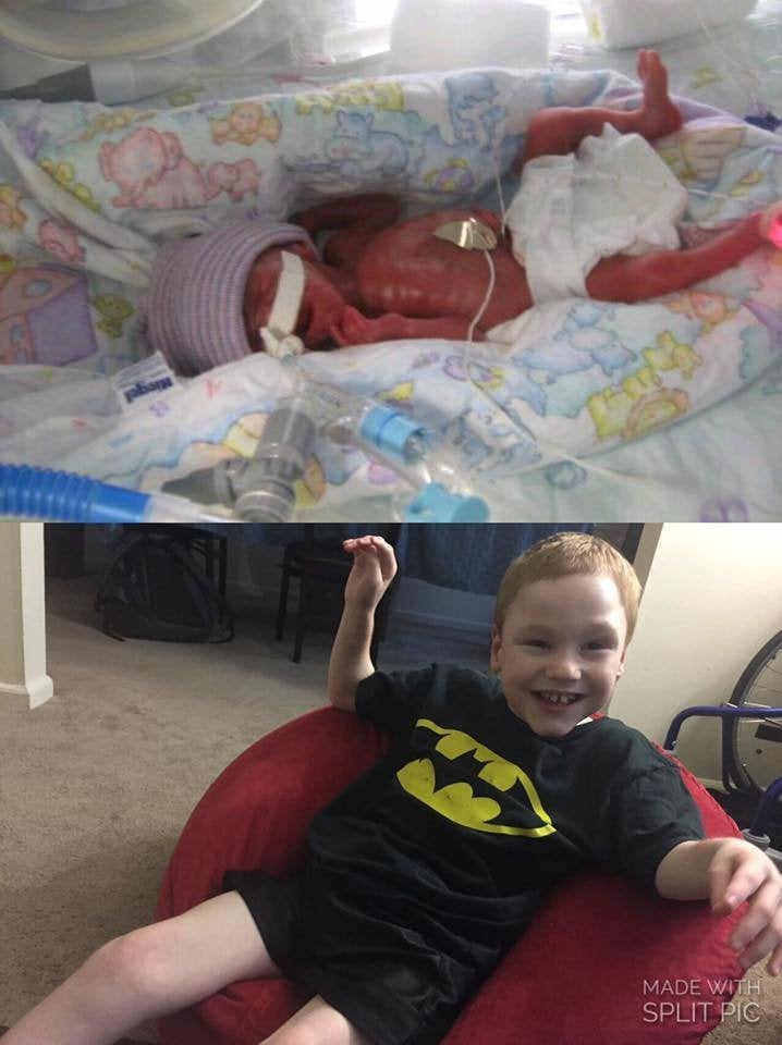 Photos Of Premature Babies Then And Now Show Their Incredible Journey Huffpost Life