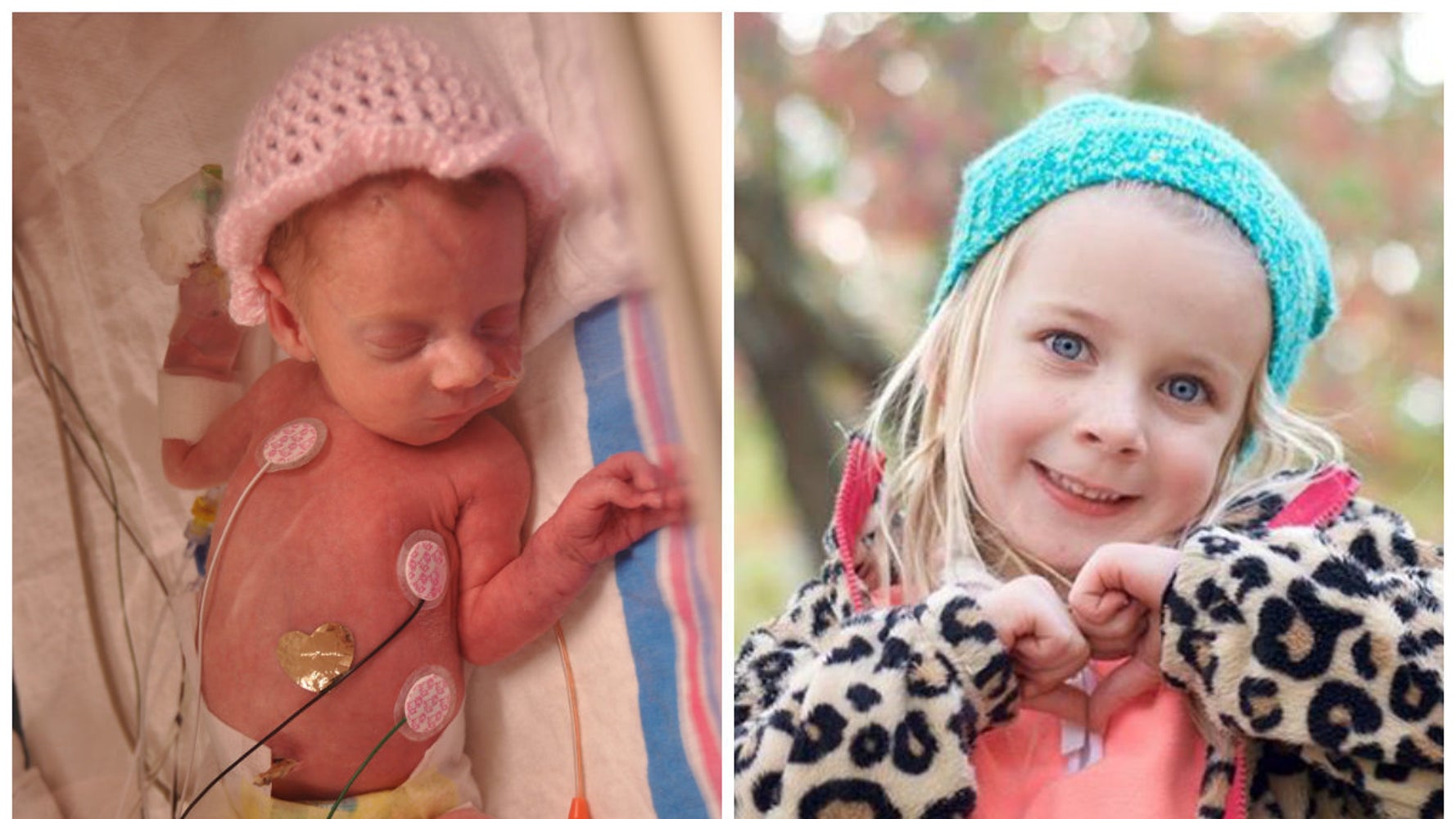 Photos Of Premature Babies Then And Now Show Their Incredible Journey Huffpost Life Photos Of Premature Babies Then And Now Show Their Incredible Journey Huffpost Life