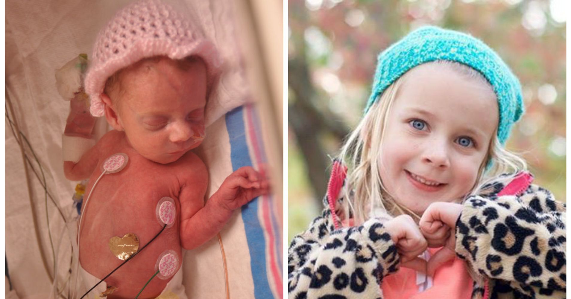 Photos Of Premature Babies  Then  And Now  Show Their 