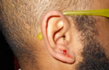 The cut taxi driver Yemaj Adem suffered to his ear.