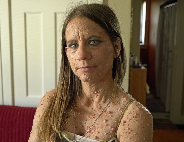 Rare Skin Disease Leaves Woman Covered In Almost 6 000 Tumours Huffpost Uk Life