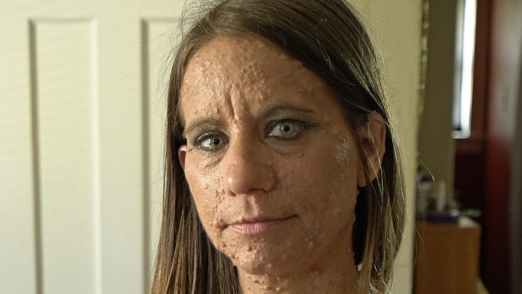 Rare Skin Disease Leaves Woman Covered In Almost 6 000 Tumours