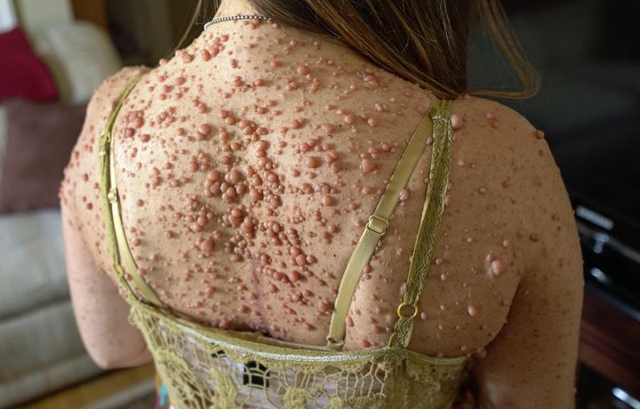 Rare Skin Disease Leaves Woman Covered In Almost 6 000 Tumours Huffpost Uk Life