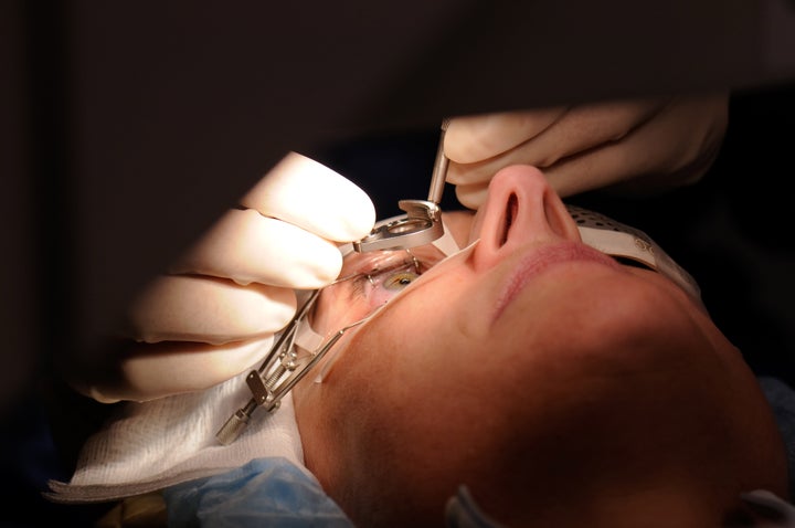lasik eye surgery