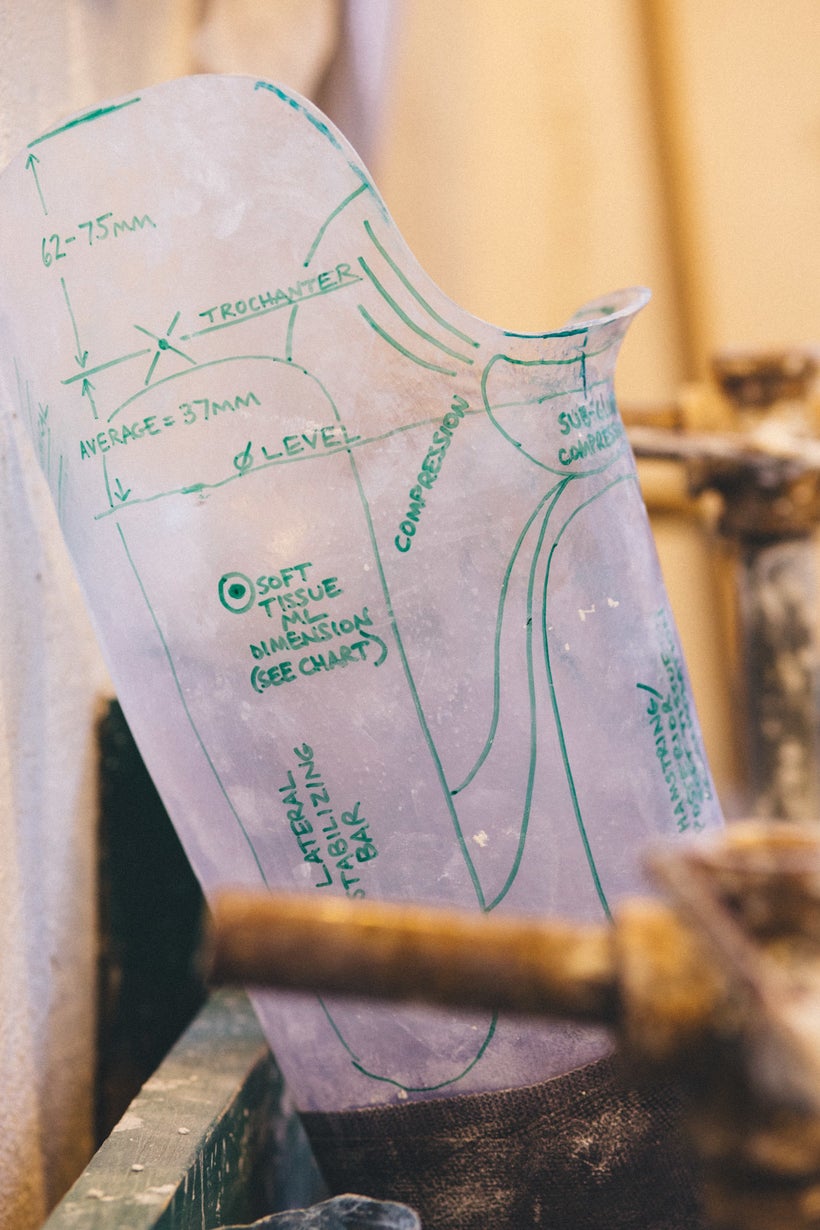 Custom Prosthesis