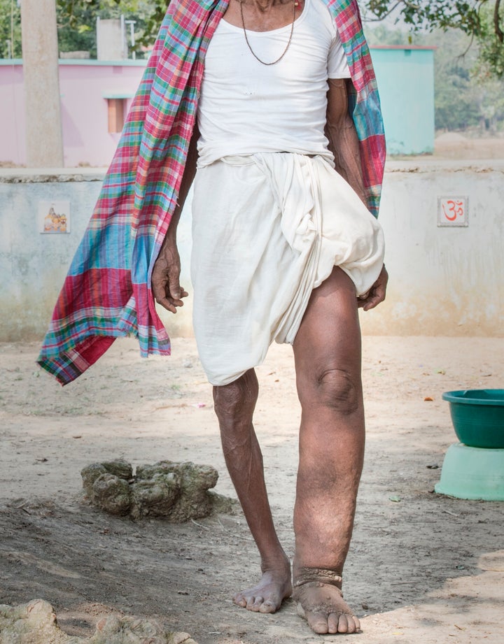 A man in India displaying symptoms of lymphatic filariasis, commonly known as elephantiasis, a neglected tropical disease that causes skin and tissue swelling.