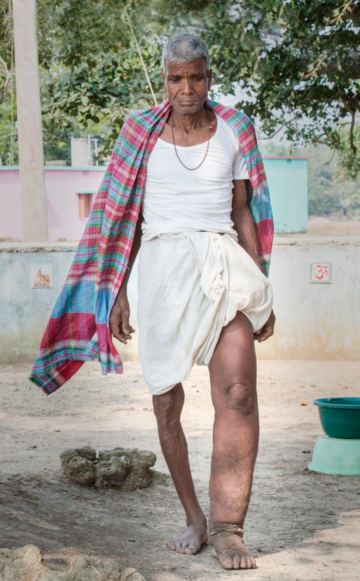A man in India displaying symptoms of lymphatic filariasis, commonly known as elephantiasis, a neglected tropical disease that causes skin and tissue swelling.