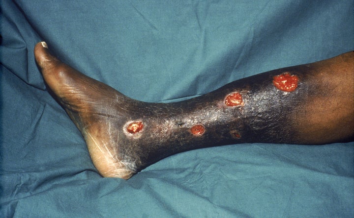 Yaws is an infection of the skin, bones and joints caused by bacteria. The photo here shows yaws affecting a patient's tibia.