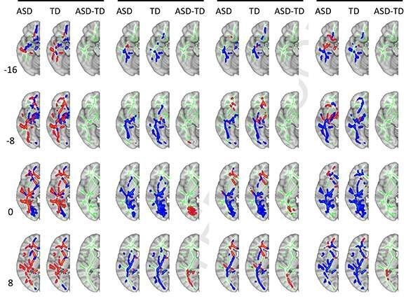 MRI scans show that white matter connections in the brains of people with autism are more balanced between hemispheres.