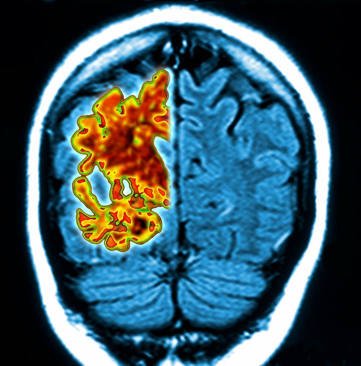 Composite image of a computer graphic of a vertical (coronal) slice through the brain of an Alzheimer's patient (orange) overlaid on a magnetic resonance imaging (MRI) scan of a normal brain (blue). The Alzheimer's brain is considerably shrunken.