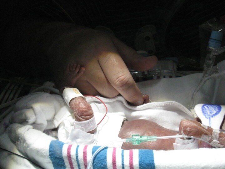 James was born prematurely a 22 weeks, six days and weighed just 15 ounces.