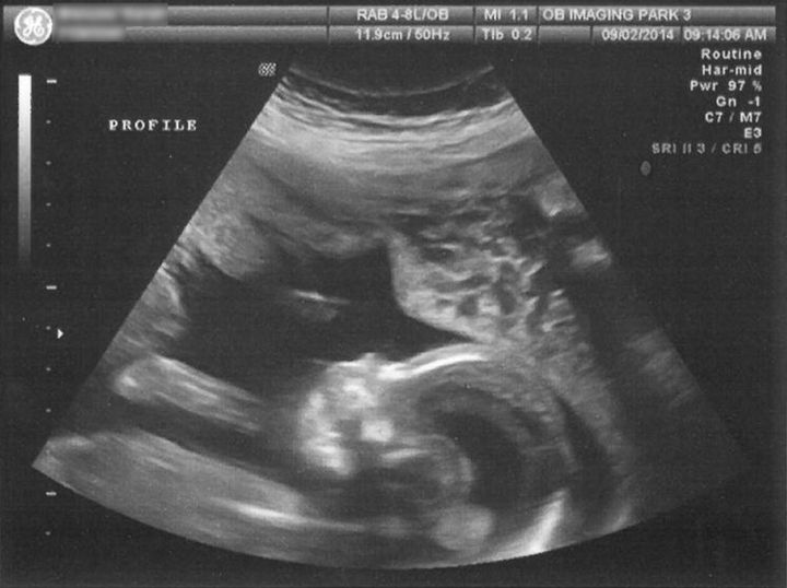 An ultrasound of Sarah B.'s fetus shows an excess of cerebrospinal fluid (the dark part of the brain), which caused his ventricles to swell.