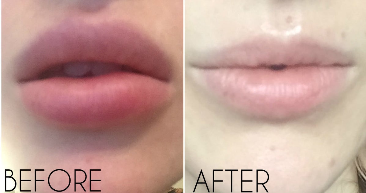 Lip Filler Removal Guide From How Hyaluronidase Works To