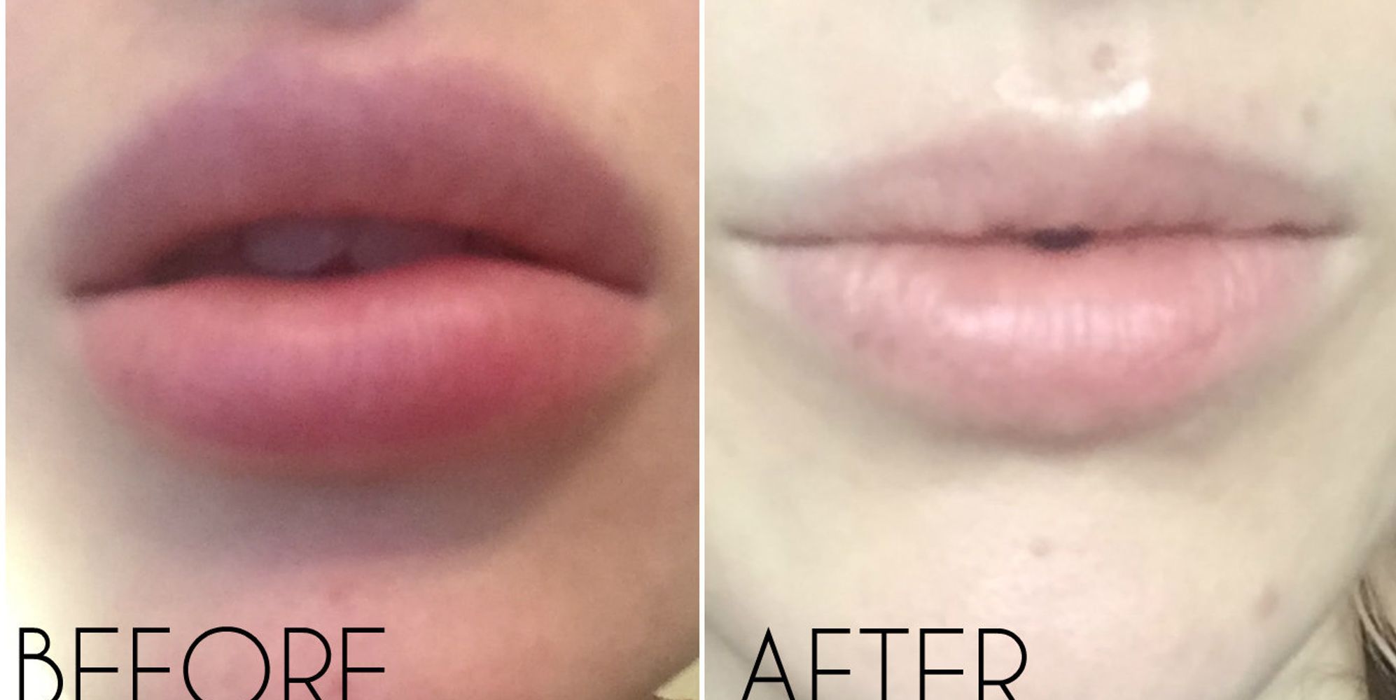 Lip Filler Removal Guide: From How Hyaluronidase Works, To Picking A ...