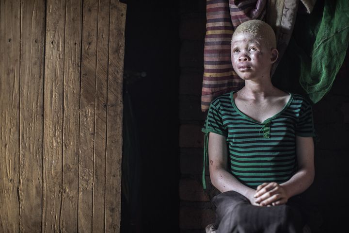 Catherine Amidu , a 12-year-old Malawian albino girl, sits in her home, in Nkole, Machinga, on April 17, 2015. Six albinos have been killed in the nation since December, according to the Association of Persons with Albinism in Malawi.