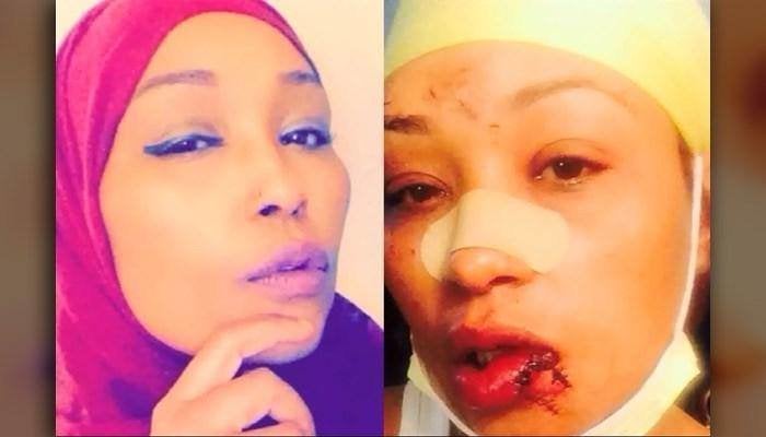 Asma Jama before the October 2015 attack (left) and after (right)