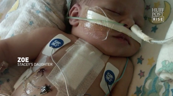 Zoe had her first open-heart surgery at just 15 hours old.