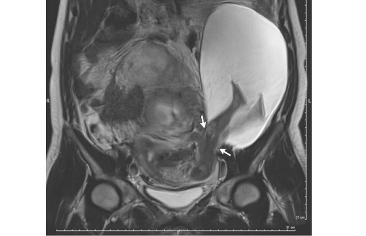 This image, taken using magnetic resonance imaging, shows the developing fetus in the woman's uterus. The two white arrows indicate the point where the woman's uterine wall ruptured and the amniotic sac, which is the large white spot, spilled out. The fetus's legs are visible in the amniotic sac.