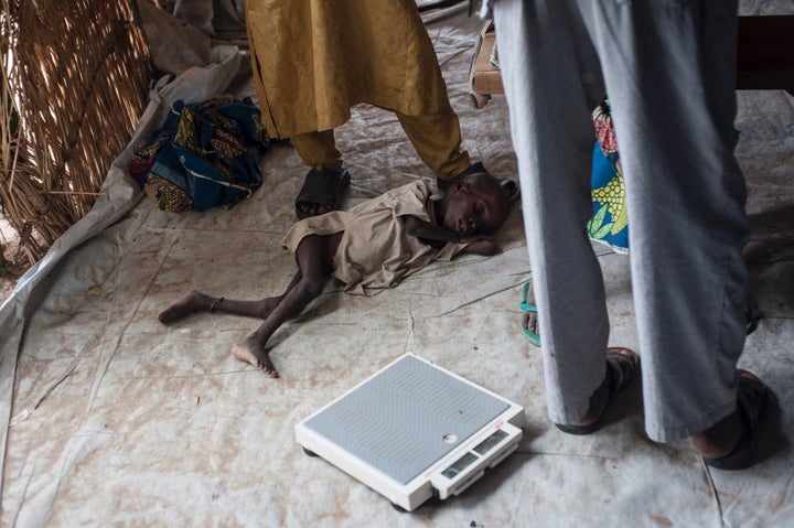 This boy is being treated for severe acute malnutrition in June at a Unicef nutrition clinic in Muna camp, which houses
