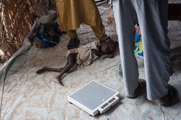 This boy is being treated for severe acute malnutrition in June at a Unicef nutrition clinic in Muna camp, which houses nearly 16,000 internally displaced people, on the outskirts of Maiduguri in Borno State, northeastern Nigeria.