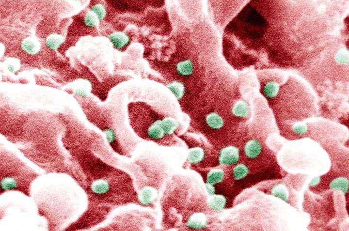 The HIV-1 virus (visible as multiple green bumps) burgeons from a cell surface.