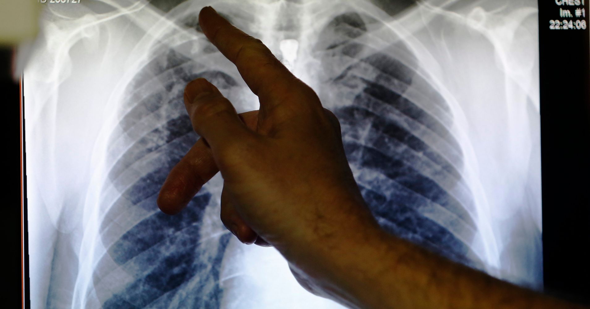 tuberculosis-causes-as-many-global-deaths-as-hiv-aids-huffpost