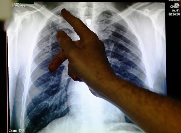 Clinical lead Doctor Al Story points to an x-ray showing a pair of lungs infected with TB (tuberculosis) during an interview with Reuters on board the mobile X-ray unit screening for TB in Ladbroke Grove in London January 27, 2014. The only mobile unit testing for TB in the country works with the most vulnerable to the disease including the homeless, drug and alcohol dependent. REUTERS/Luke MacGregor
