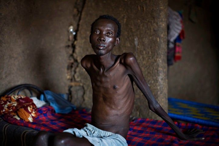 A tuberculosis patient in Sudan. Tuberculosis is the top infectious killer in the world.