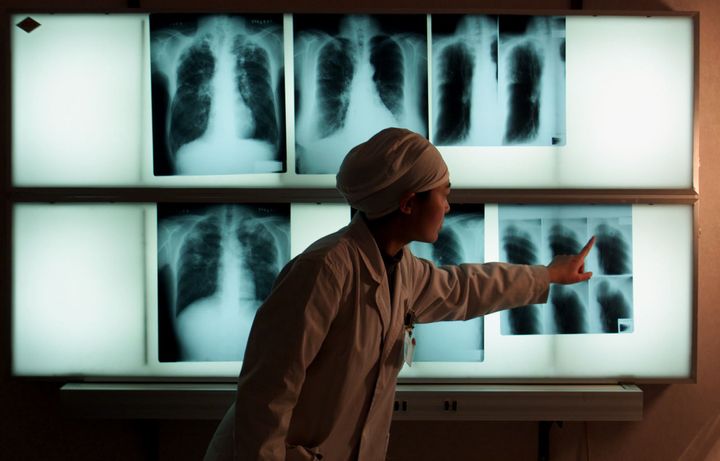 A Chinese doctor examines an x-ray of a tuberculosis patient at the Beijing Tuberculosis Hospital March 18. TB has surpassed HIV/AIDS as the world's most deadly infectious disease.