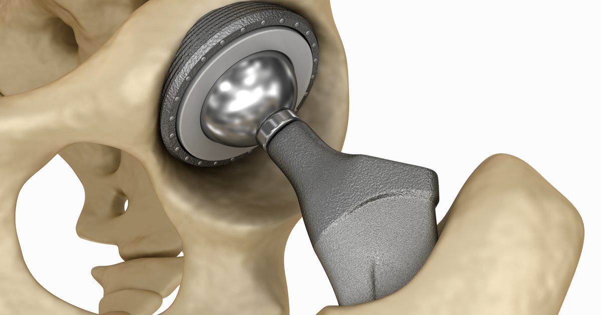 Judge Halves $1 Billion Award In Johnson & Johnson Hip Implant Case ...