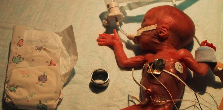 Baby Zoe weighed 10.8 ounces when she was born at 27 weeks. The hospital's smallest diapers were too large for her and f