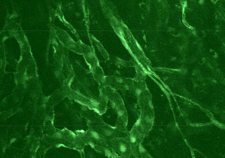 Vascular structure in a brain metastatic breast cancer in a mouse evaluated by intravital microscopy  