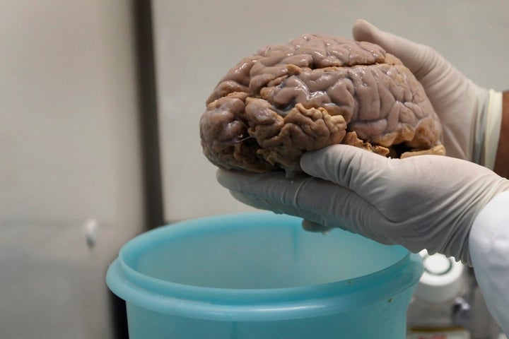 <p>A researcher holds a brain with Alzheimer's disease.</p>