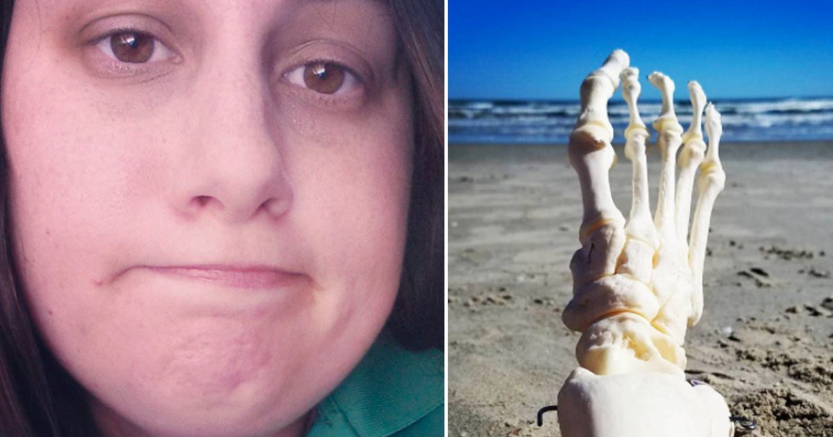 Cancer Survivor Takes Her Amputated Foot On Many Adventures With