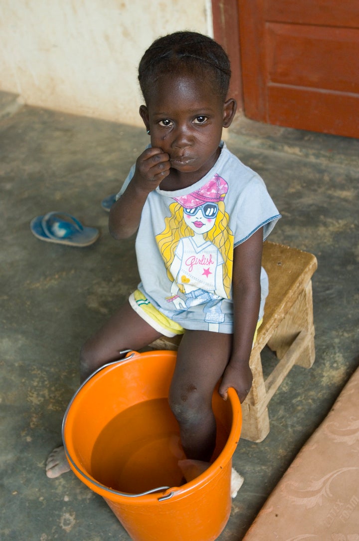 A patient with a Guinea worm emerging soaks her foot to try to coax it out at the Savelugu Case Containment Center.