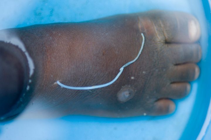 A patient with a Guinea worm emerging at the Savelugu Case Containment Center.