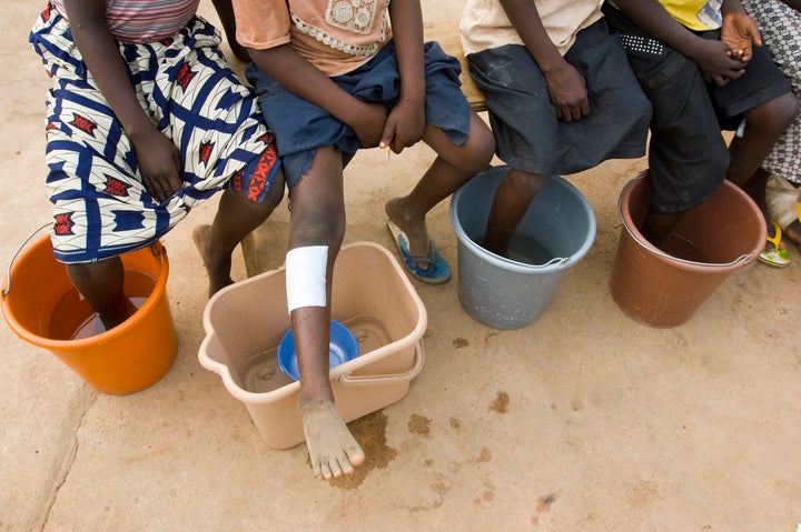 Patients with Guinea worms emerging soak their feet in cold water to hasten the painful emergence at the Savelugu Case Containment Center.