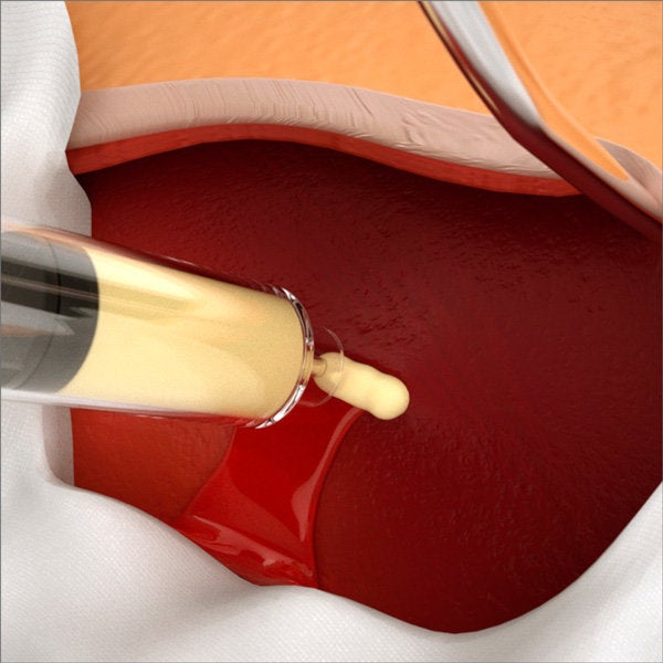 This Incredible Gel Stops Bleeding Immediately HuffPost UK