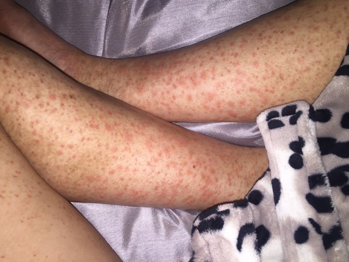The rash across her legs. 
