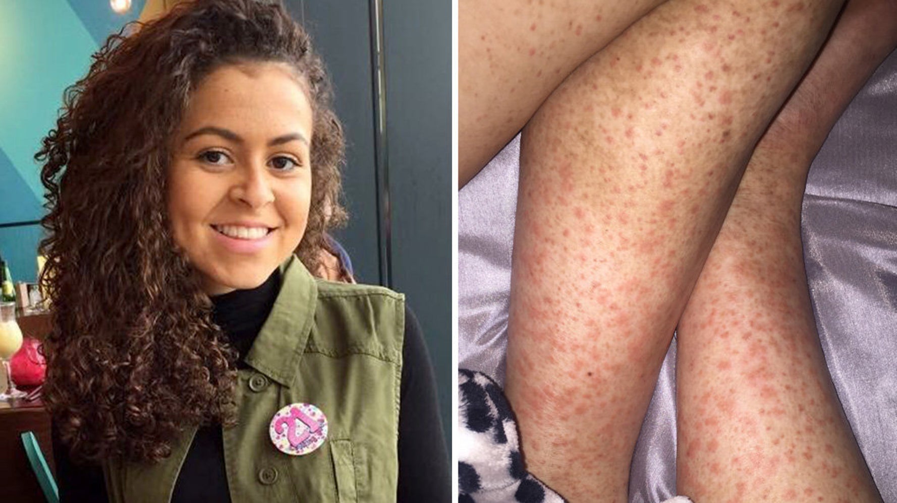 Woman s Shaving Rash On Legs Turned Out To Be Symptom Of Cancer