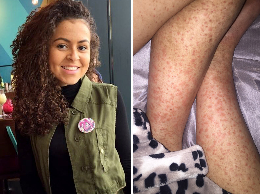 Woman s Shaving Rash On Legs Turned Out To Be Symptom Of Cancer