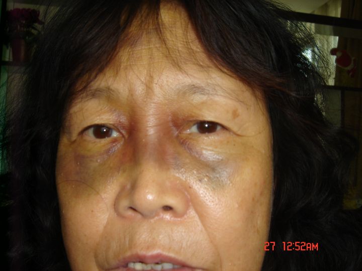 Huuchinhuu after being beaten during her clandestine imprisonment. 
