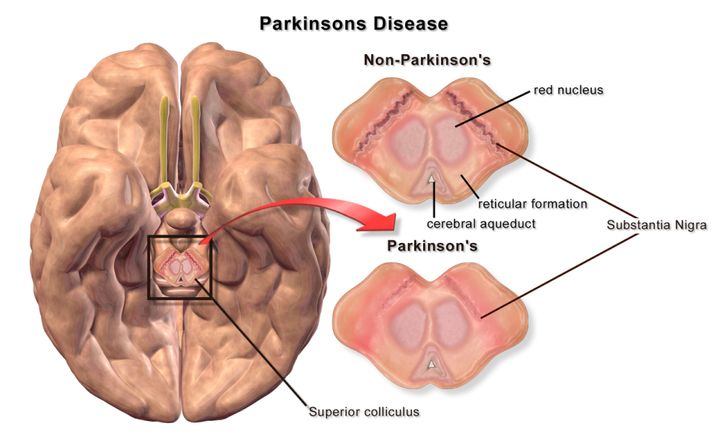 Partial cross section of a human brain. In Parkinson’s disease, nerve cells in the substantia nigra are progressively lost. These cells normally produce the neurotransmitter dopamine (DOPA) which helps control body movements. Individuals with PD are typically prescribed increasing amounts of a form of DOPA to compensate for the loss of these nerve cells.