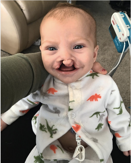 Brody now has a gastrostomy button (G-button) on his stomach to help with feeding. This photo was taken before his first cleft repair surgery.