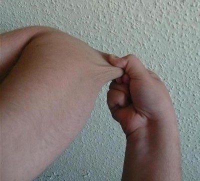 One common sign of EDS is skin hyperextensibility. In this photo, a 16-year-old white male EDS patient shows the stretchiness of his arm’s skin by pulling at it with his fingers.