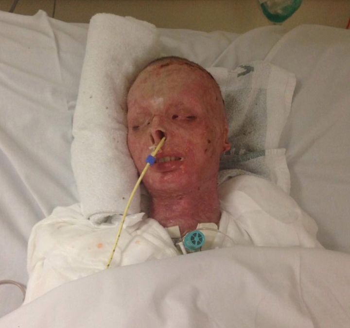 Troy Mackinlay was given just a 5 percent chance of survival after he was caught in a house fire 