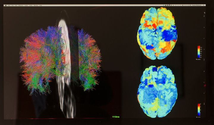 fMRI images of a brain. 