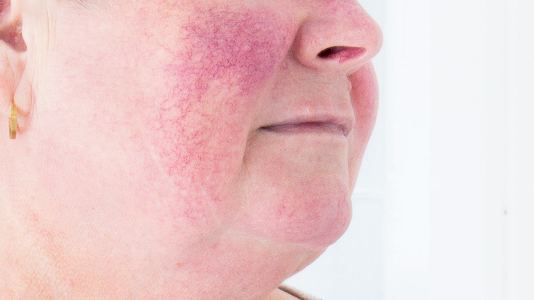 Beauty,skincare,Rosacea. 