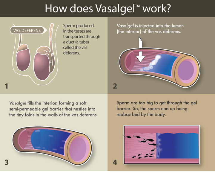 An explanation of how Vasalgel works.